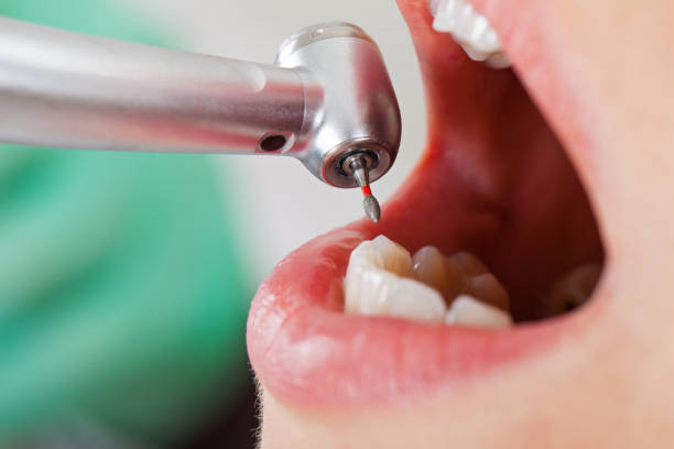 Best Knocked-Out Tooth (Avulsed Tooth) Treatment in Wyong, MI